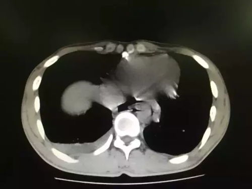 男子吃饭狼吞虎咽把食管吃破了 男子吃饭狼吞虎咽把食管吃破了