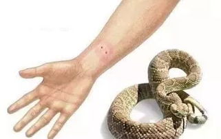 专家提醒被蛇咬后这九大土方法危险 专家提醒被蛇咬后这九大土方法危险