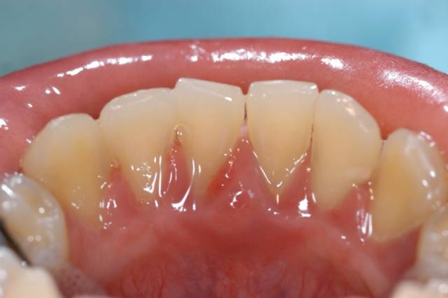 北大韦神牙齿脱落 家属称患牙周炎 北大韦神牙齿脱落 家属称患牙周炎