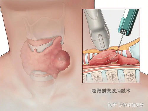 专家:硫脲可损伤甲状腺及多个器官 专家:硫脲可损伤甲状腺及多个器官