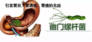 26岁女生患胃癌:疑因幽门螺旋杆菌 26岁女生患胃癌:疑因幽门螺旋杆菌