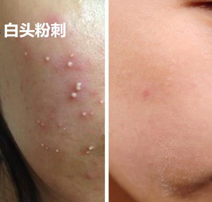 如何去除痘痘效果好(怎样去除痘痘效果好) 如何去除痘痘效果好(怎样去除痘痘效果好)