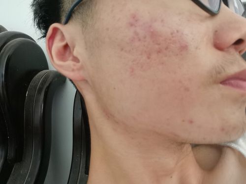 如何去除痘痘效果好(怎样去除痘痘效果好) 如何去除痘痘效果好(怎样去除痘痘效果好)