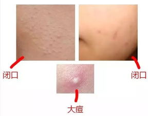 如何去除痘痘效果好(怎样去除痘痘效果好) 如何去除痘痘效果好(怎样去除痘痘效果好)