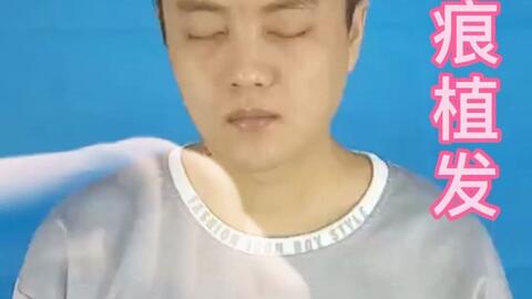 植发多少钱一根(植发多少钱一根? 植发多少钱一根(植发多少钱一根?