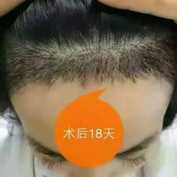 植发多少钱一根(植发多少钱一根? 植发多少钱一根(植发多少钱一根?