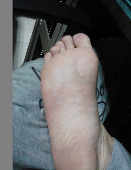 脚上起小水泡很痒是什么原因（脚上起小水泡很痒是什么引起的）