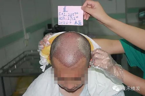 植发有用吗?可以维持多久(植发有用吗?可以维持多久呢) 植发有用吗?可以维持多久(植发有用吗?可以维持多久呢)