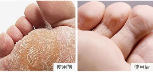 脚脱皮不痒不臭只脱皮是怎么回事(脚脱皮不痒不臭只脱皮用什么治疗) 脚脱皮不痒不臭只脱皮是怎么回事(脚脱皮不痒不臭只脱皮用什么治疗)