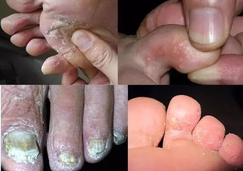 脚脱皮不痒不臭只脱皮是怎么回事(脚脱皮不痒不臭只脱皮用什么治疗) 脚脱皮不痒不臭只脱皮是怎么回事(脚脱皮不痒不臭只脱皮用什么治疗)