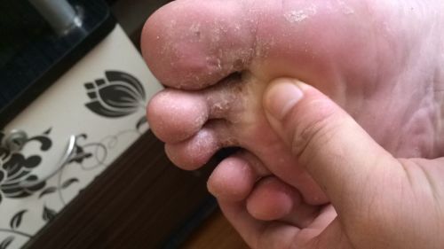 脚脱皮不痒不臭只脱皮是怎么回事(脚脱皮不痒不臭只脱皮用什么治疗) 脚脱皮不痒不臭只脱皮是怎么回事(脚脱皮不痒不臭只脱皮用什么治疗)