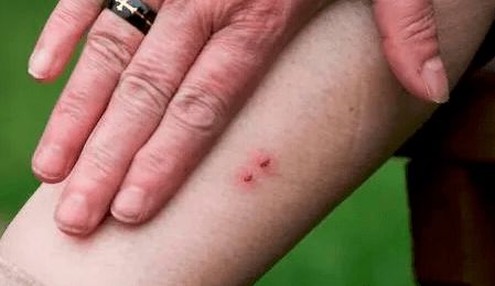 梦见自己被蛇咬伤出血什么预兆:梦见自己被蛇咬伤出血什么预兆? 梦见自己被蛇咬伤出血什么预兆:梦见自己被蛇咬伤出血什么预兆?