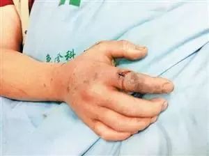 梦见自己被蛇咬伤出血什么预兆:梦见自己被蛇咬伤出血什么预兆? 梦见自己被蛇咬伤出血什么预兆:梦见自己被蛇咬伤出血什么预兆?