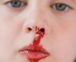 梦见自己流鼻血好不好：梦见自己流鼻血好不好？解密潜意识中的心理暗示