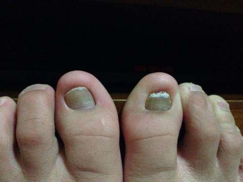 灰指甲的治疗方法:灰指甲的治疗方法全解析,从根源清除到日常护理 灰指甲的治疗方法:灰指甲的治疗方法全解析,从根源清除到日常护理