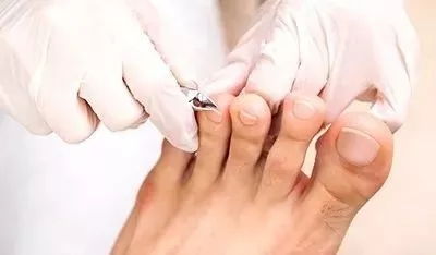 灰指甲的治疗方法:灰指甲的治疗方法全解析,从根源清除到日常护理 灰指甲的治疗方法:灰指甲的治疗方法全解析,从根源清除到日常护理