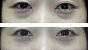 消除眼袋:告别眼袋,重拾明亮眼神,深入了解与解决方案 消除眼袋:告别眼袋,重拾明亮眼神,深入了解与解决方案