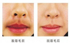 正规医院脱唇毛价格:脱唇毛价格大揭秘!正规医院详细报价与选择指南 正规医院脱唇毛价格:脱唇毛价格大揭秘!正规医院详细报价与选择指南