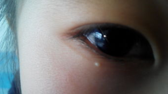 眼皮上面长了白点：眼皮上面长了白点？可能是这些原因！