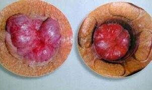 内痔和外痔的区别图片:一文看懂,内痔和外痔的区别(附图解析) 内痔和外痔的区别图片:一文看懂,内痔和外痔的区别(附图解析)