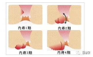 内痔和外痔的区别图片:一文看懂,内痔和外痔的区别(附图解析) 内痔和外痔的区别图片:一文看懂,内痔和外痔的区别(附图解析)