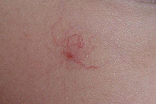 容易被误诊为荨麻疹的疾病:警惕!这些疾病容易被误诊为荨麻疹 容易被误诊为荨麻疹的疾病:警惕!这些疾病容易被误诊为荨麻疹