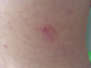 容易被误诊为荨麻疹的疾病:警惕!这些疾病容易被误诊为荨麻疹 容易被误诊为荨麻疹的疾病:警惕!这些疾病容易被误诊为荨麻疹