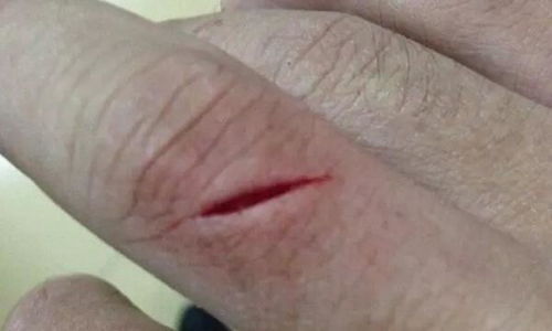 容易被误诊为荨麻疹的疾病:警惕!这些疾病容易被误诊为荨麻疹 容易被误诊为荨麻疹的疾病:警惕!这些疾病容易被误诊为荨麻疹