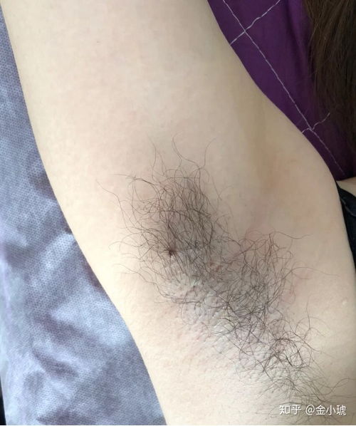 以前没有腋臭突然有了:突然袭来的困扰,从无腋臭到被它包围的蜕变与自救 以前没有腋臭突然有了:突然袭来的困扰,从无腋臭到被它包围的蜕变与自救