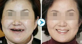 种牙的后遗症亲身经历:种牙后遗症,我的真实经历与反思 种牙的后遗症亲身经历:种牙后遗症,我的真实经历与反思