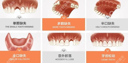 种牙的后遗症亲身经历:种牙后遗症,我的真实经历与反思 种牙的后遗症亲身经历:种牙后遗症,我的真实经历与反思