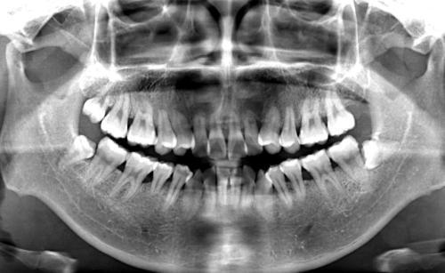 种牙的后遗症亲身经历:种牙后遗症,我的真实经历与反思 种牙的后遗症亲身经历:种牙后遗症,我的真实经历与反思