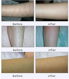 永久脱毛一般需要多少钱:永久脱毛到底要花多少钱?详细解析影响价格的关键因素 永久脱毛一般需要多少钱:永久脱毛到底要花多少钱?详细解析影响价格的关键因素