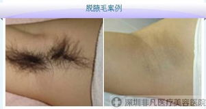 永久脱毛一般需要多少钱:永久脱毛到底要花多少钱?详细解析影响价格的关键因素 永久脱毛一般需要多少钱:永久脱毛到底要花多少钱?详细解析影响价格的关键因素