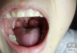 扁桃体发炎用什么药最佳:扁桃体发炎用什么药最佳?科学用药指南 扁桃体发炎用什么药最佳:扁桃体发炎用什么药最佳?科学用药指南