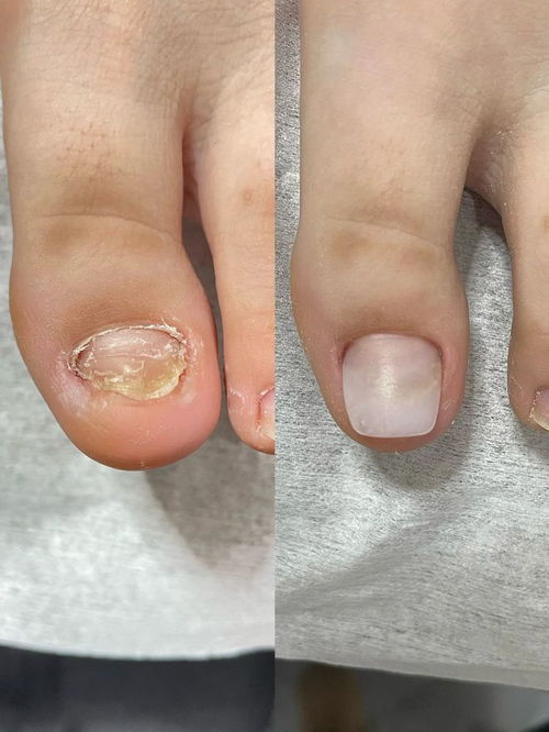 治灰指甲最快最好方法:灰指甲困扰?这些最快最好的治疗方法你一定要知道! 治灰指甲最快最好方法:灰指甲困扰?这些最快最好的治疗方法你一定要知道!