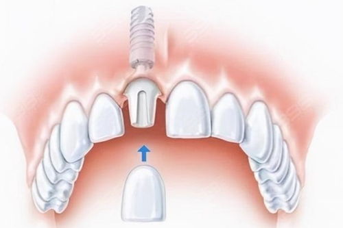 爱尔创全瓷牙800元：惊爆！爱尔创全瓷牙800元？这可能是你今年最大的牙齿美容捡漏机会！