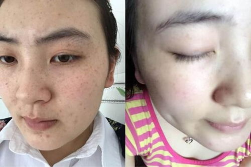 雀斑彻底根治的小偏方:天然温和告别顽固雀斑?这些小偏方或可助你焕亮肌肤! 雀斑彻底根治的小偏方:天然温和告别顽固雀斑?这些小偏方或可助你焕亮肌肤!