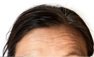 男生如何去除抬头纹:男生必看!告别抬头纹,重塑清爽精神面貌的实用指南 男生如何去除抬头纹:男生必看!告别抬头纹,重塑清爽精神面貌的实用指南