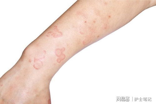 荨麻疹对身体的影响:警惕!荨麻疹不只是皮肤问题,它对身体的影响远超想象 荨麻疹对身体的影响:警惕!荨麻疹不只是皮肤问题,它对身体的影响远超想象