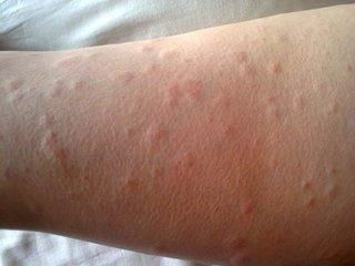 荨麻疹对身体的影响:警惕!荨麻疹不只是皮肤问题,它对身体的影响远超想象 荨麻疹对身体的影响:警惕!荨麻疹不只是皮肤问题,它对身体的影响远超想象