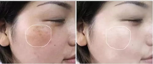 怎么才能去掉老年斑:老年斑困扰?这些方法帮你有效去除,重焕肌肤光采! 怎么才能去掉老年斑:老年斑困扰?这些方法帮你有效去除,重焕肌肤光采!