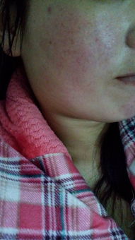 脸上反复过敏是什么原因引起的:为什么你的脸总是过敏?反复面部过敏的常见原因与应对 脸上反复过敏是什么原因引起的:为什么你的脸总是过敏?反复面部过敏的常见原因与应对