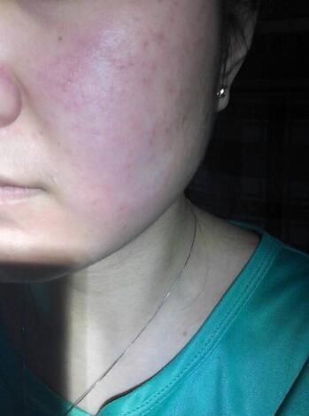 脸上反复过敏是什么原因引起的:为什么你的脸总是过敏?反复面部过敏的常见原因与应对 脸上反复过敏是什么原因引起的:为什么你的脸总是过敏?反复面部过敏的常见原因与应对