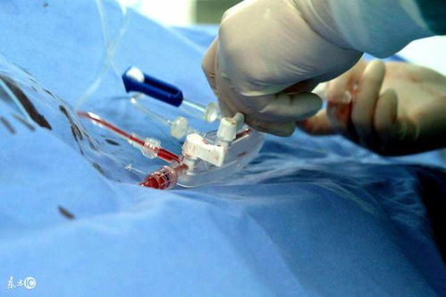 用过宫腔镜基本上就废了:宫腔镜,真的会废掉女性吗? 用过宫腔镜基本上就废了:宫腔镜,真的会废掉女性吗?