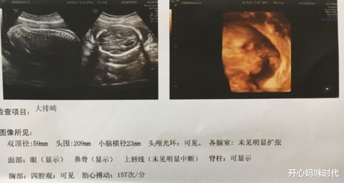 孕16周胎儿小鸡彩超图:揭秘孕16周胎儿彩超图,小鸡形态惊喜展现! 孕16周胎儿小鸡彩超图:揭秘孕16周胎儿彩超图,小鸡形态惊喜展现!