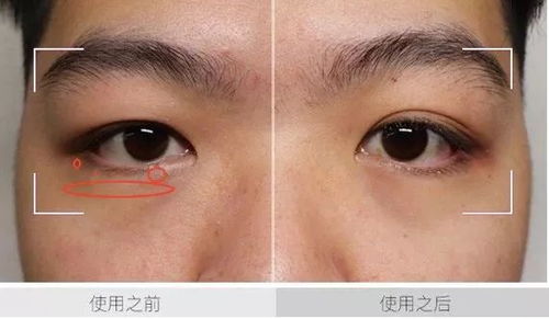 如何治疗眼袋:告别小熊猫眼,全面解析眼袋的成因与治疗方案 如何治疗眼袋:告别小熊猫眼,全面解析眼袋的成因与治疗方案