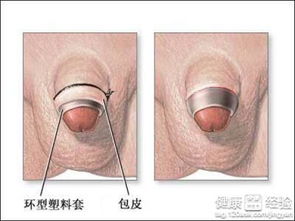 25岁割包茎是不是晚了:25岁割包茎,真的晚了吗?揭开包茎矫正的年龄迷思 25岁割包茎是不是晚了:25岁割包茎,真的晚了吗?揭开包茎矫正的年龄迷思