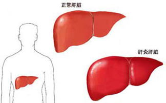 肝肿瘤11cm能活多久:肝肿瘤11cm能活多久?晚期肝癌患者的生存期与预后分析 肝肿瘤11cm能活多久:肝肿瘤11cm能活多久?晚期肝癌患者的生存期与预后分析
