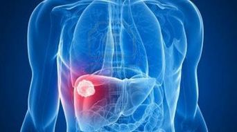 肝肿瘤11cm能活多久:肝肿瘤11cm能活多久?晚期肝癌患者的生存期与预后分析 肝肿瘤11cm能活多久:肝肿瘤11cm能活多久?晚期肝癌患者的生存期与预后分析